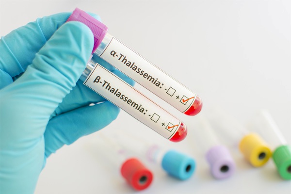 Xét nghiệm Thalassemia khảo sát các bất thường ở hồng cầu