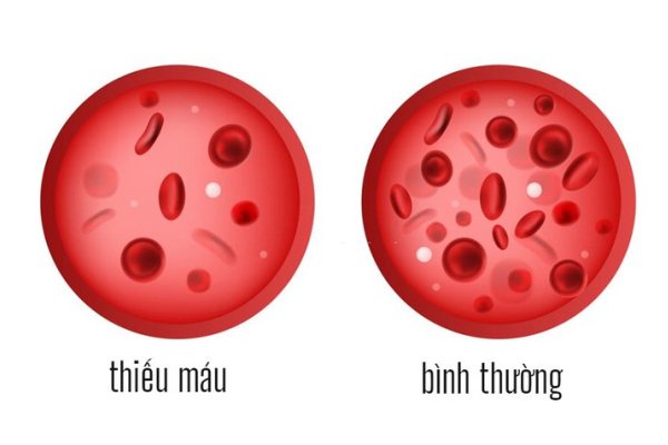 Thalassemia gây tình trạng thiếu máu