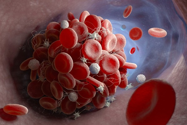 Hội chứng Thrombophilia gây huyết khối