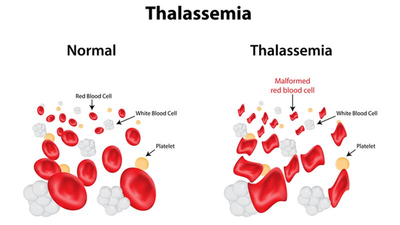 Tan máu bẩm sinh (Thalassemia)